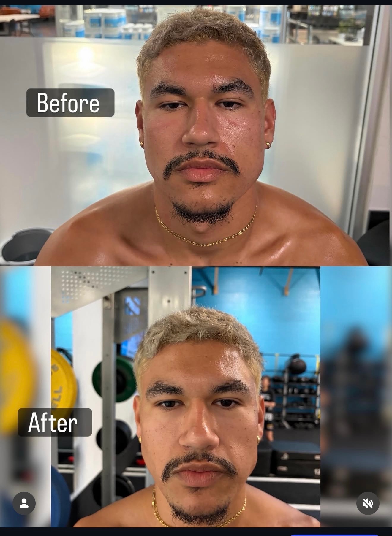 Before and after image supplied by ORT for The Facelift Method™