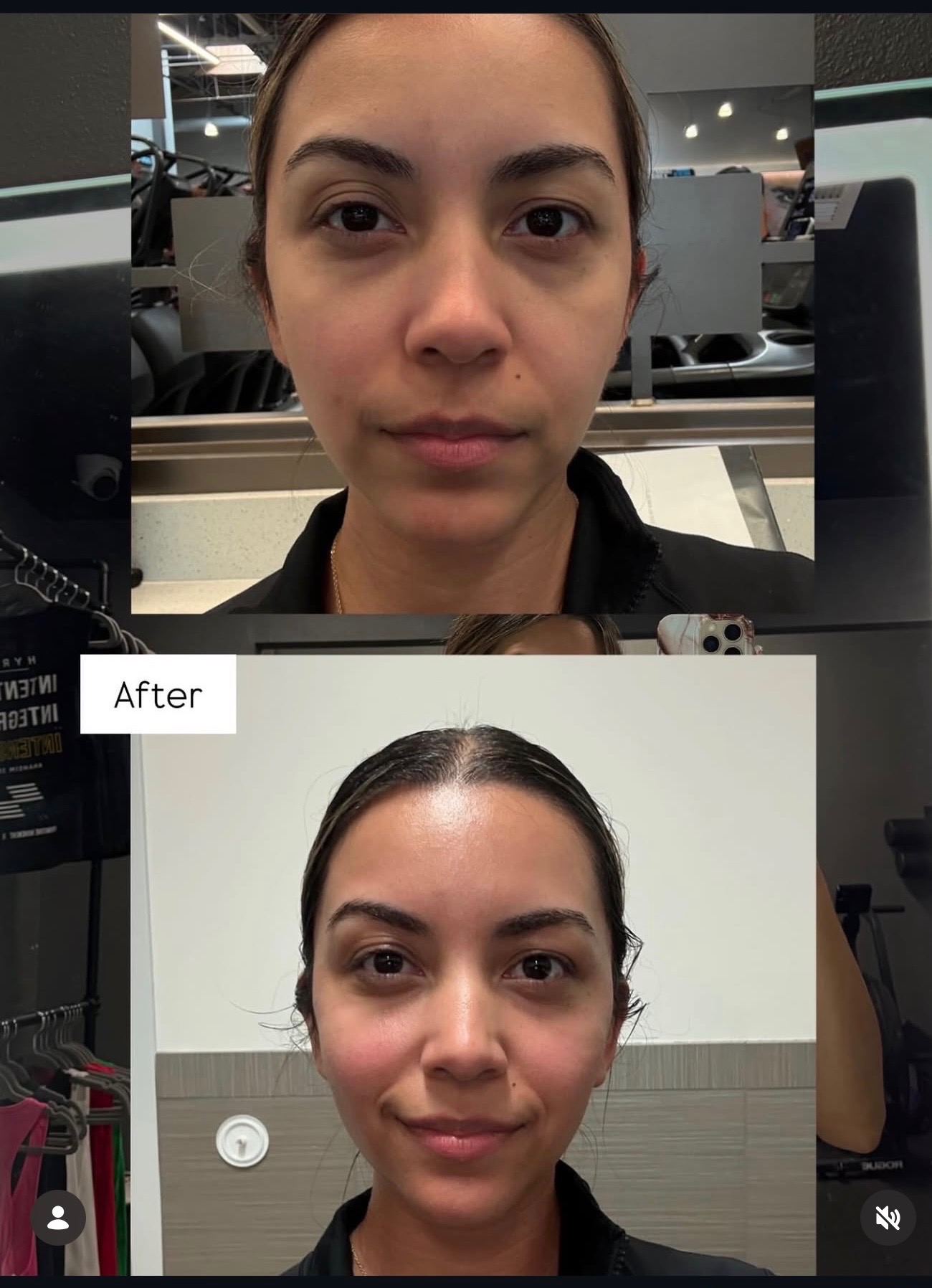 Second before and after image supplied by ORT for The Facelift Method™